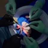 Kidney Transplant