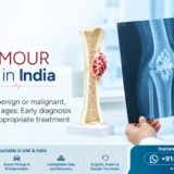 iMW-India-News-blog-post_Bone-Tumor